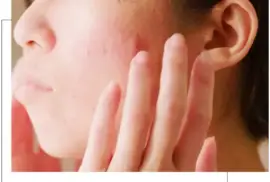 Skin Sensitivity and hydrated - Carragheen