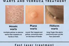 Unveil Radiant Skin: Premier Warts and Verruca Treatment in Brighton!