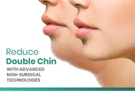 Double Chin Removal in Islamabad ,Exercise - Rehman Medical Center