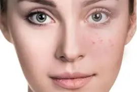 Best Acnes Cars Treatment in Islamabad - Rehman Medical Center