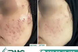 Best Acnes Cars Treatment in Islamabad - Rehman Medical Center