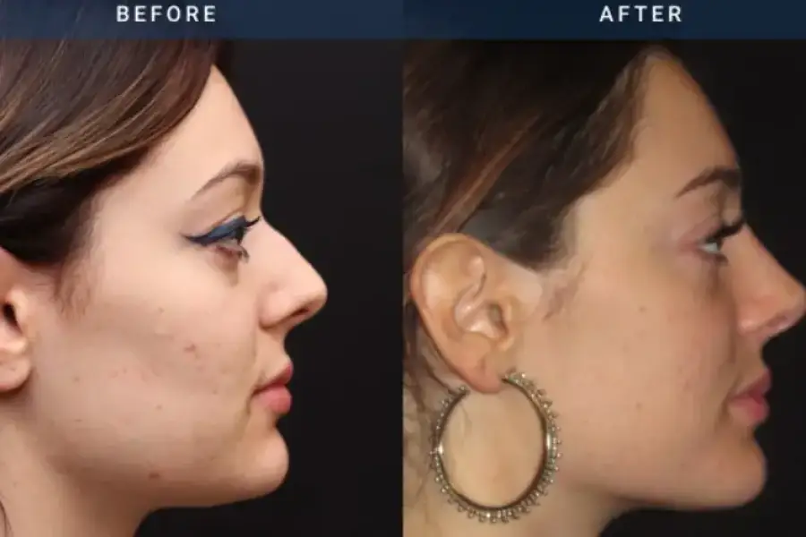 Non-surgical Rhinoplasty in Slough | BMACS Clinic