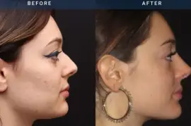 Non-surgical Rhinoplasty in Slough | BMACS Clinic