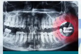 Wisdom Tooth Extraction: What to Expect & How to Prepare