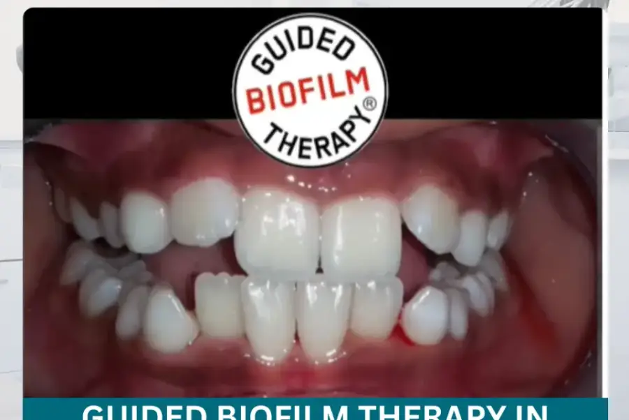 Guided Biofilm Therapy in Hyderabad