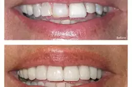 Teeth Straightening in Nokomis, FL