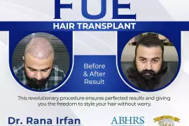 BEST FUE HAIR TRANSPLANT IN ISLAMABAD 