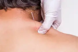 Pain Management with Dry Needling Techniques